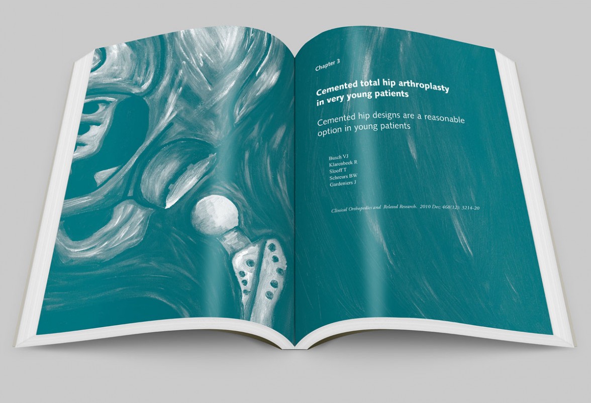 young osteoarthritic hip